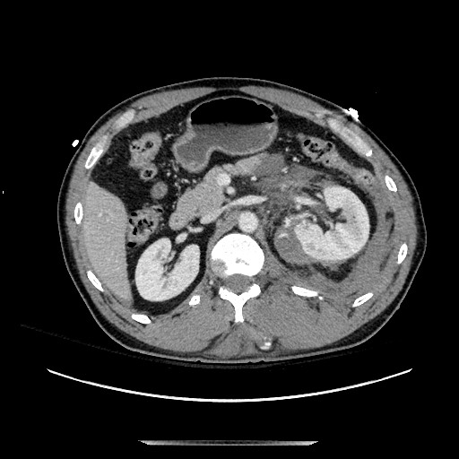 Blunt abdominal trauma with solid organ and musculoskelatal injury with active extravasation (Radiopaedia 68364-77895 A 52).jpg