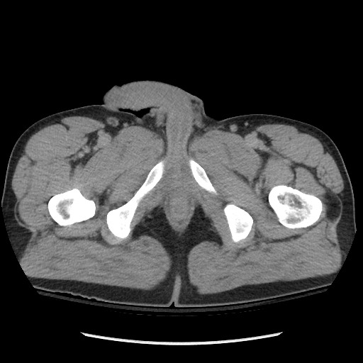 File:Blunt abdominal trauma with solid organ and musculoskelatal injury with active extravasation (Radiopaedia 68364-77895 Axial C+ delayed 147).jpg