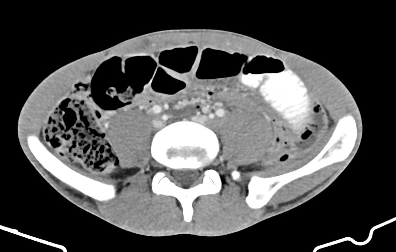 Blunt injury to the small bowel (Radiopaedia 74953-85987 A 124).jpg