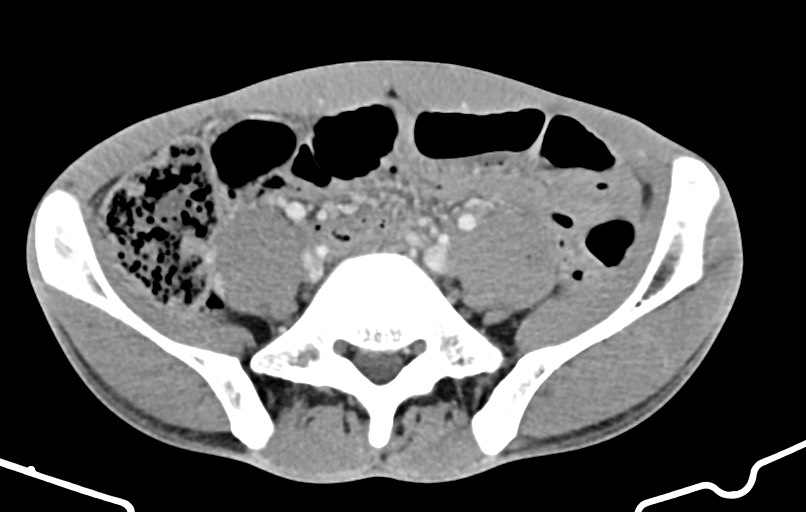 Blunt injury to the small bowel (Radiopaedia 74953-85987 A 134).jpg