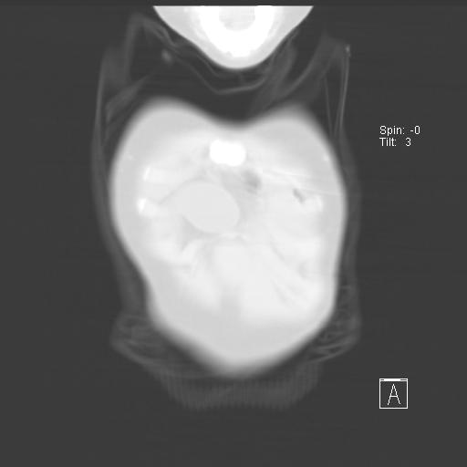 File:Bochdalek diaphragmatic hernia (Radiopaedia 38866-41059 Coronal lung window 1).jpg