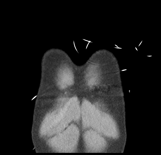 File:Boerhaave syndrome (Radiopaedia 39382-41661 B 5).png