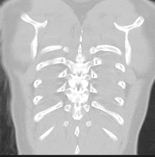 Boerhaave syndrome (Radiopaedia 39382-41661 Coronal lung window 46).png
