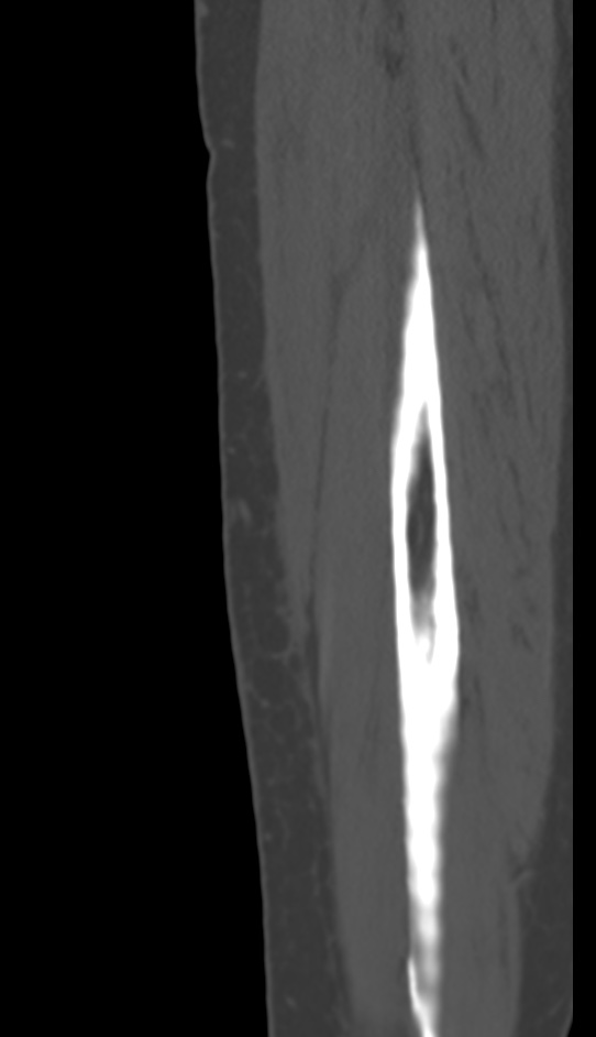 Bone metastasis - tibia (Radiopaedia 57665-64609 Sagittal bone window 167).jpg