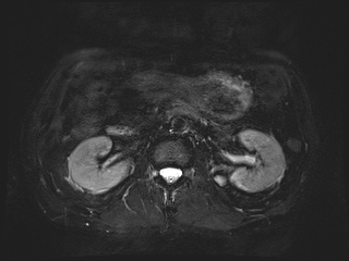File:Bouveret syndrome (Radiopaedia 61017-68856 Axial MRCP 33).jpg