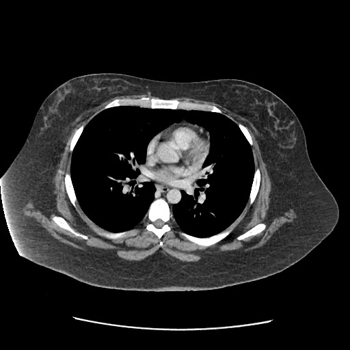 Bowel and splenic infarcts in acute lymphocytic leukemia (Radiopaedia 61055-68915 A 3).jpg