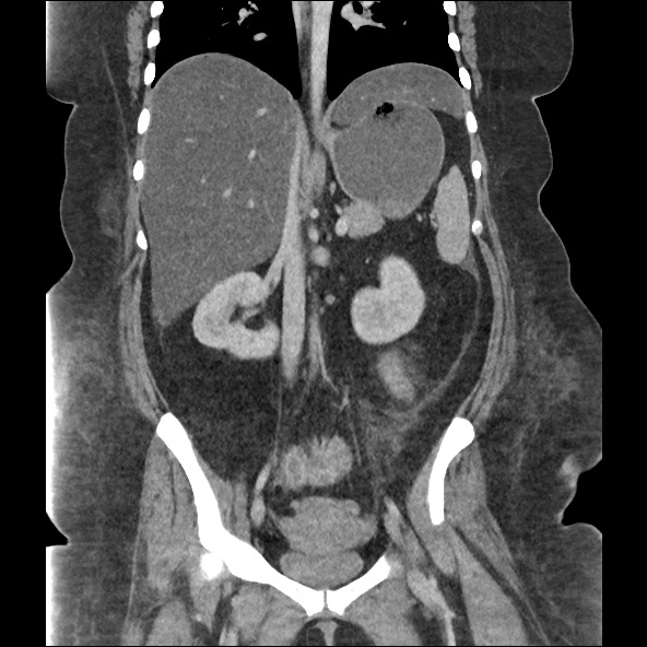 File:Bowel and splenic infarcts in acute lymphocytic leukemia (Radiopaedia 61055-68915 B 35).jpg