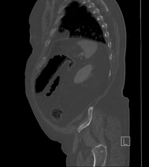 Bowel ischemia secondary to SMA occlusion with extensive portomesenteric venous gas (Radiopaedia 54656-60871 Sagittal bone window 19).jpg