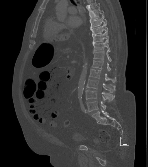 Bowel ischemia secondary to SMA occlusion with extensive portomesenteric venous gas (Radiopaedia 54656-60871 Sagittal bone window 52).jpg