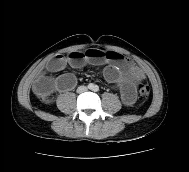 Bowel obstruction from colon carcinoma (Radiopaedia 22995-23028 A 51).jpg