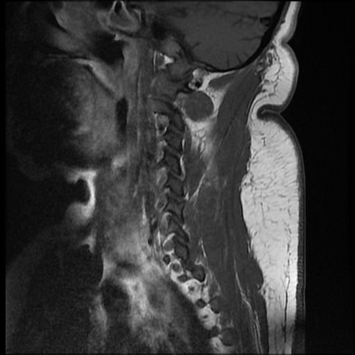 File:Brachial plexopathy (Radiopaedia 21844-21806 Sagittal T1 C+ 10).jpg