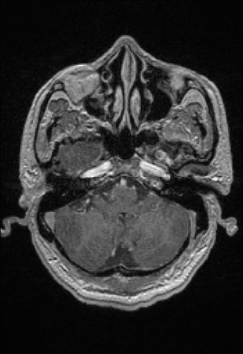 Brain abscess with ventriculitis (Radiopaedia 85703-101495 Axial T1 C+ 43).jpg