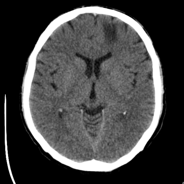 Brain metastases from lung cancer (Radiopaedia 24480-24781 Axial non-contrast 23).jpg