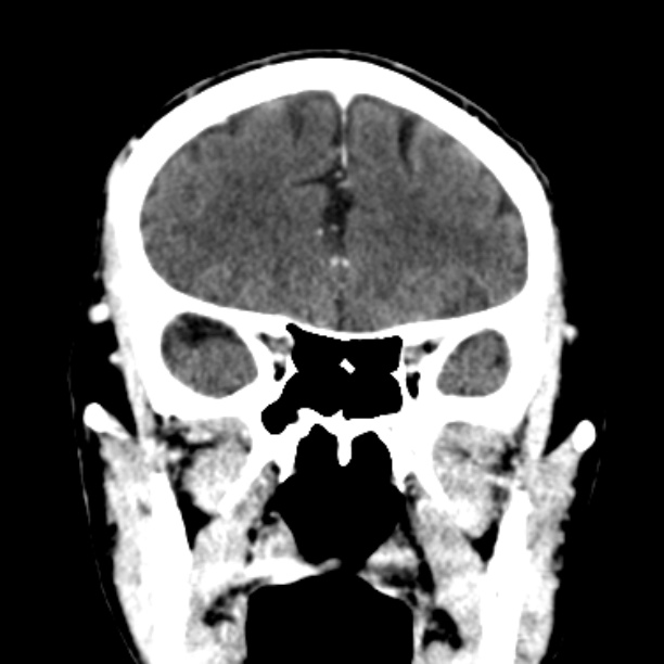 Brain metastases from lung cancer (Radiopaedia 27849-28092 Coronal C+ delayed 20).jpg