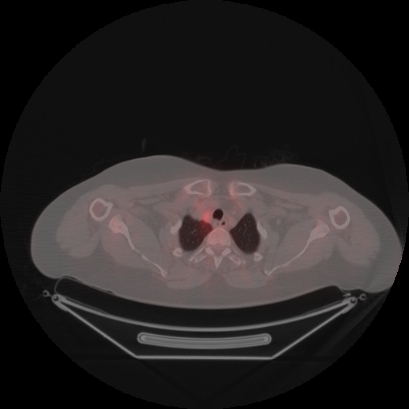 Brain metastasis (Radiopaedia 89847-106962 Axial lung window 3).jpg