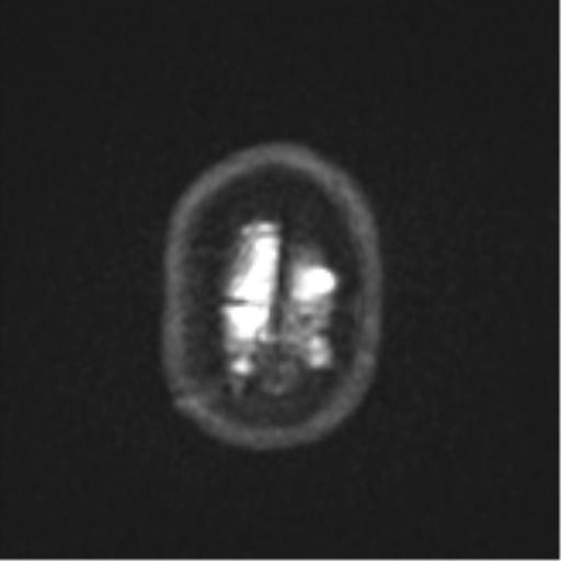 Brain metastasis (lung cancer) (Radiopaedia 48289-53179 Axial DWI 27).png