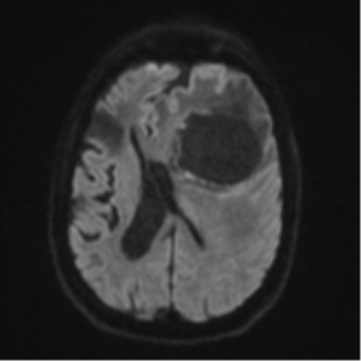 Brain metastasis (lung cancer) (Radiopaedia 48289-53179 Axial DWI 45).png