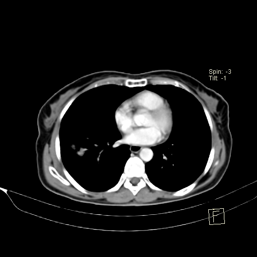 Brain metastasis as initial presentation of non-small cell lung cancer (Radiopaedia 65122-74127 A 29).jpg