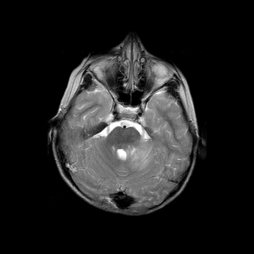 File:Brainstem ganglioglioma (Radiopaedia 10763-11224 Axial T2 14).jpg