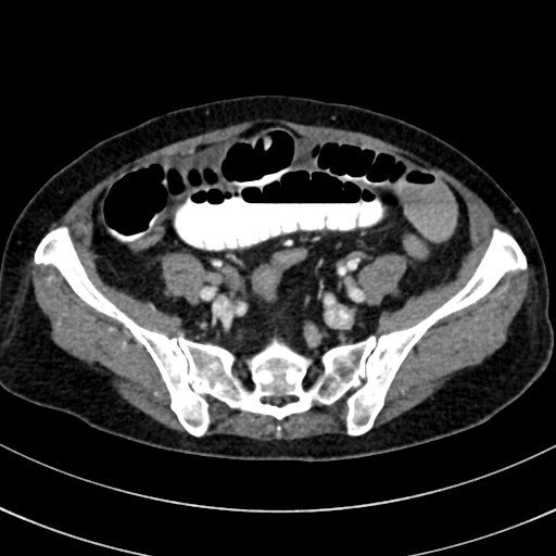 File:Broad ligament hernia (Radiopaedia 84802-100276 A 59).jpg