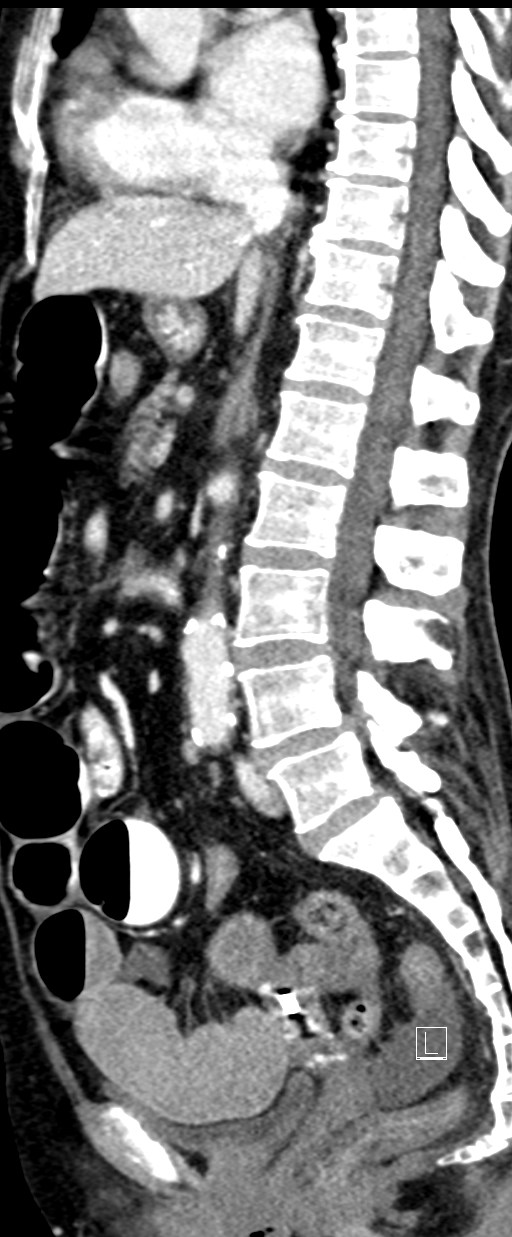 Broad ligament hernia (Radiopaedia 84802-100276 C 38).jpg