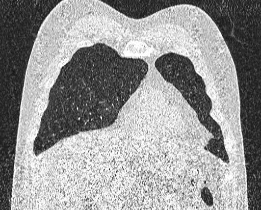 File:Bronchial atresia (Radiopaedia 58271-65417 Coronal lung window 9).jpg