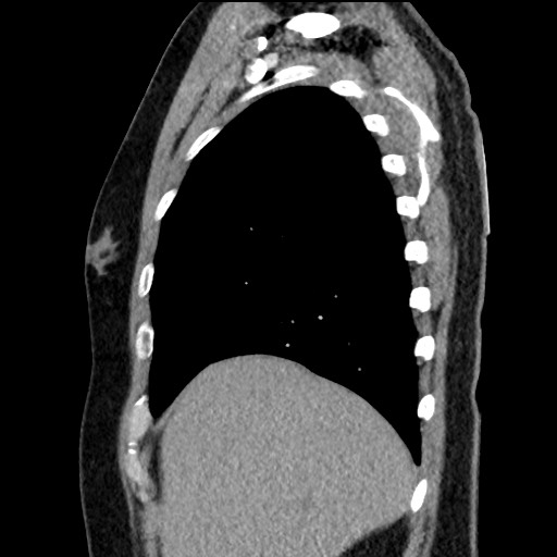 Bronchial carcinoid tumor (Radiopaedia 67377-76764 E 14).jpg