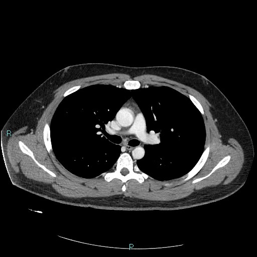 Bronchial carcinoid tumor (Radiopaedia 78272-90875 A 43).jpg