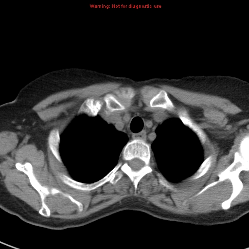 File:Bronchoalveolar carcinoma (BAC) (Radiopaedia 13436-13392 Axial non-contrast 7).jpg