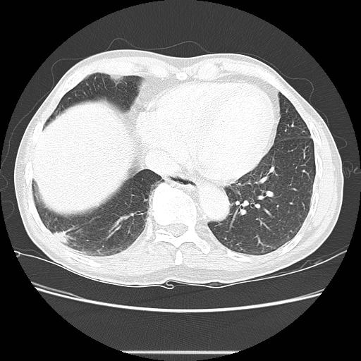 Bronchocele (Radiopaedia 17097-16795 Axial lung window 89).jpg