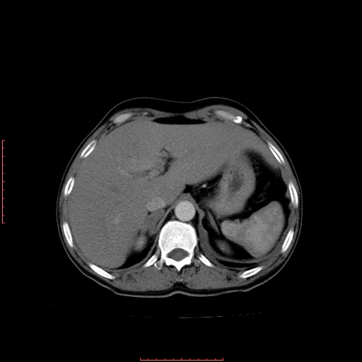 File:Bronchogenic carcinoma with left atrial large deposit - T4N3M1a (Radiopaedia 42316-45428 A 28).jpg