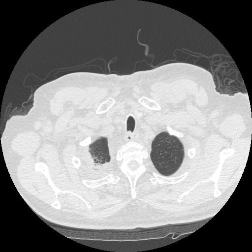 File:Bronchogenic carcinoma with metastatic lymphadenopathy (Radiopaedia 37671-39569 Axial lung window 7).jpg