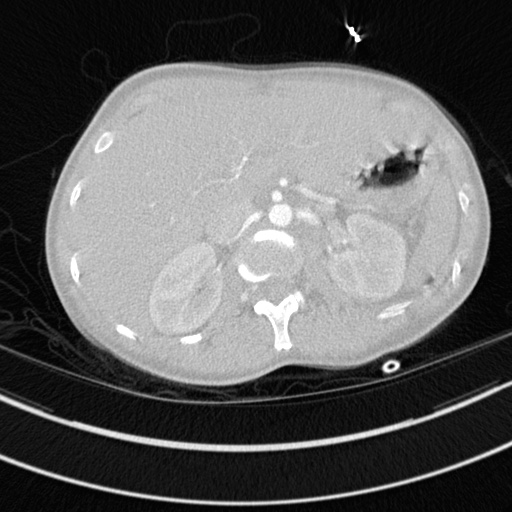 Bronchogenic cyst (Radiopaedia 77801-90071 Axial lung window 92).jpg