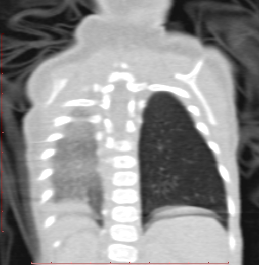 File:Bronchogenic cyst (Radiopaedia 78599-91409 Coronal lung window 181).jpg