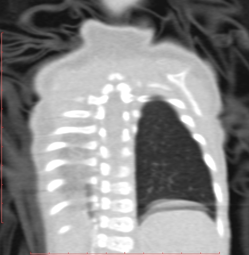 Bronchogenic cyst (Radiopaedia 78599-91409 Coronal lung window 188).jpg