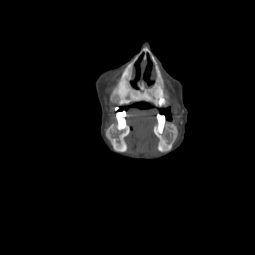 File:Brown tumor with secondary hyperparathyroidism (Radiopaedia 23591-23705 bone window 8).jpg