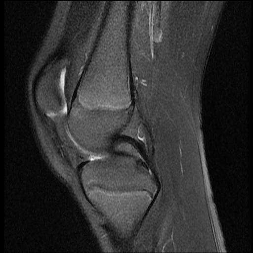 File:Bucket handle tear - lateral meniscus (Radiopaedia 72124-82634 Sagittal PD fat sat 10).jpg