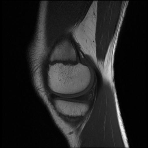 File:Bucket handle tear - lateral meniscus (Radiopaedia 72124-82634 Sagittal T1 13).jpg