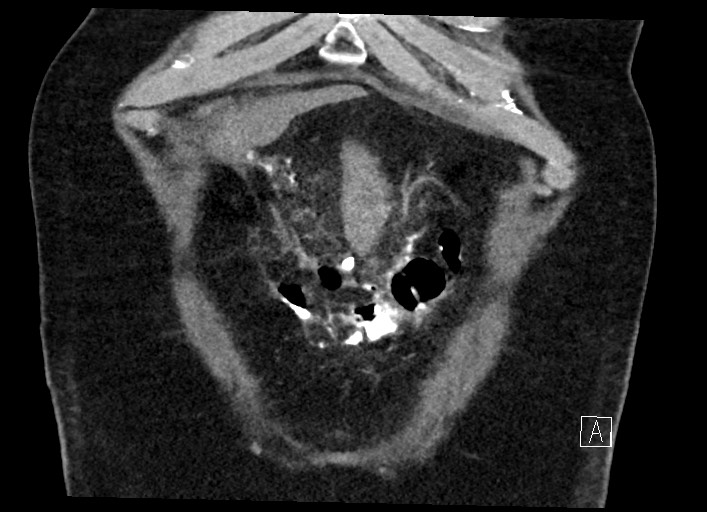 Buried bumper syndrome - gastrostomy tube (Radiopaedia 63843-72577 Coronal Inject 24).jpg