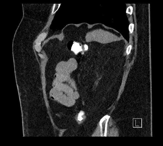 Buried bumper syndrome - gastrostomy tube (Radiopaedia 63843-72577 Sagittal Inject 19).jpg