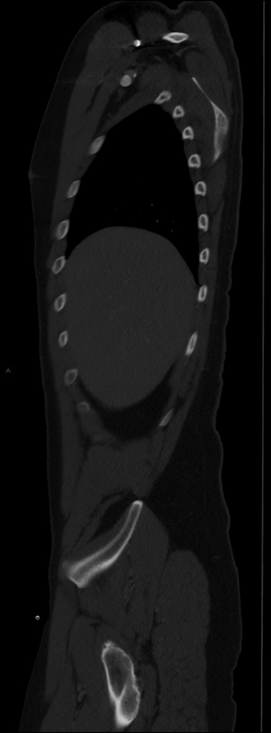 Burst fracture (Radiopaedia 83168-97542 Sagittal bone window 33).jpg