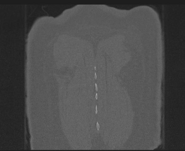 Burst fracture - thoracic spine (Radiopaedia 30238-30865 Coronal bone window 153).jpg