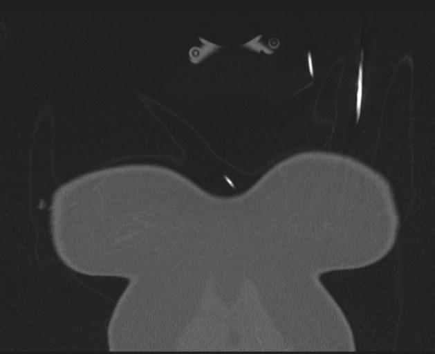 Burst fracture - thoracic spine (Radiopaedia 30238-30865 Coronal bone window 6).jpg