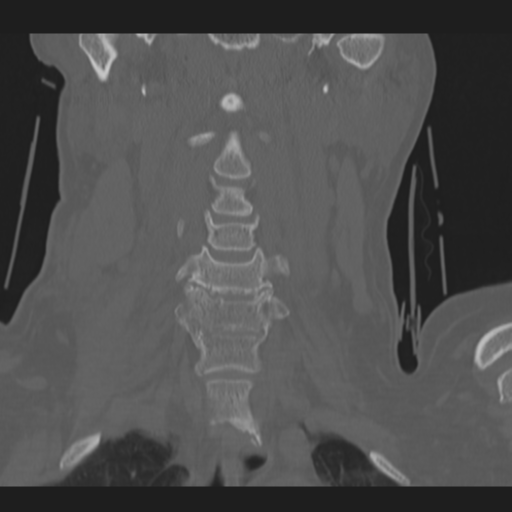 File:C2 fracture (Radiopaedia 34091-35341 Coronal bone window 16).png