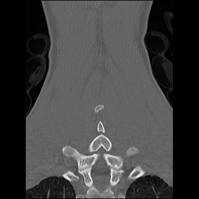 C5 facet fracture (Radiopaedia 58374-65499 Coronal bone window 46).jpg