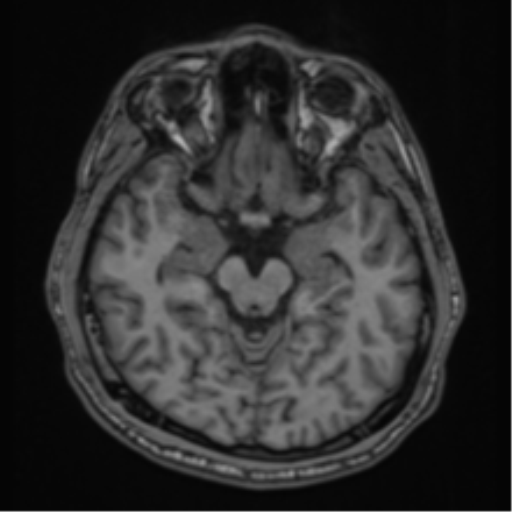 CNS vasculitis (Radiopaedia 55715-62263 Axial T1 10).png