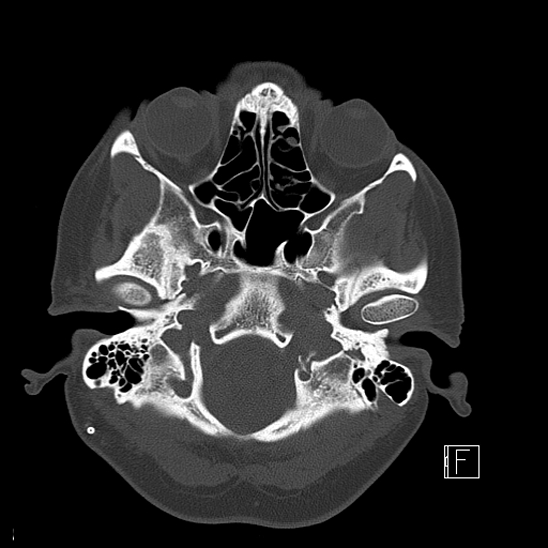 Calcified chronic subdural hematoma (Radiopaedia 77374-89492 Axial bone window 17).jpg