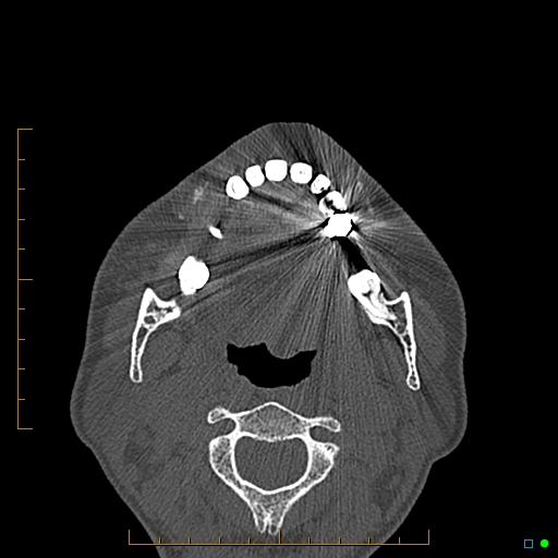 Calcified facial augmentation fillers (Radiopaedia 79514-92679 Axial bone window 106).jpg
