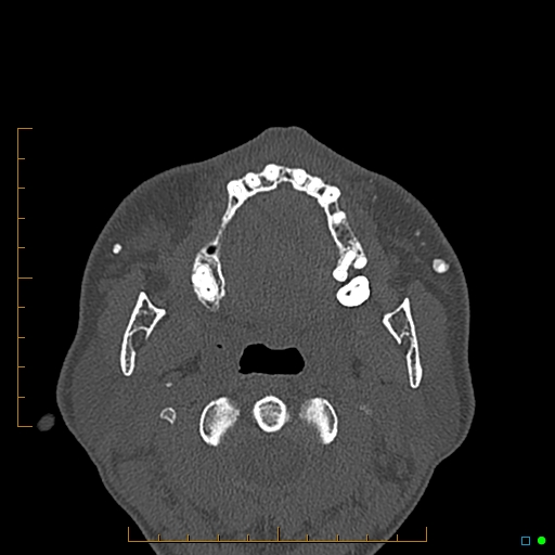 Calcified facial augmentation fillers (Radiopaedia 79514-92679 Axial bone window 83).jpg
