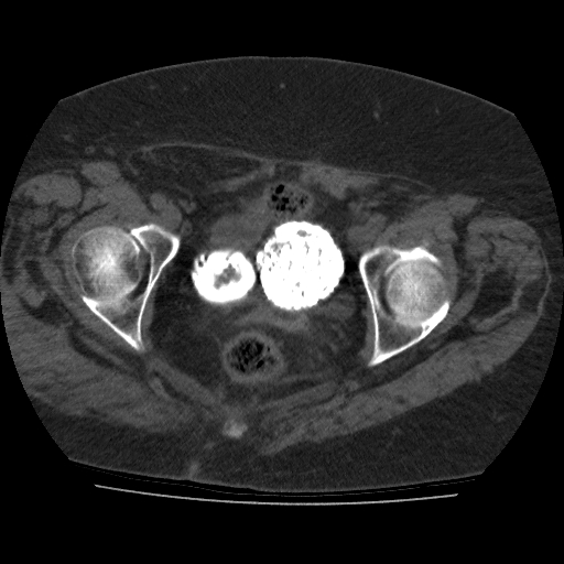 File:Calcified fibroids (Radiopaedia 16853-16579 non-contrast 12).jpg